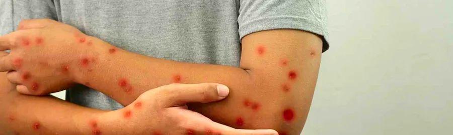 Cover Image for Mpox Travel Advisory: Crucial Information for Travelers in Light of Global Health Concerns