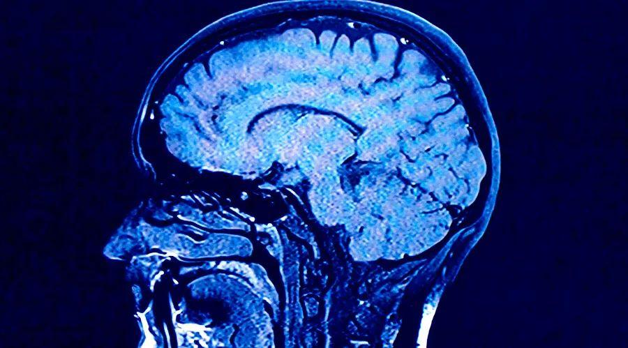 Cover Image for Why brain aging differs significantly across individuals